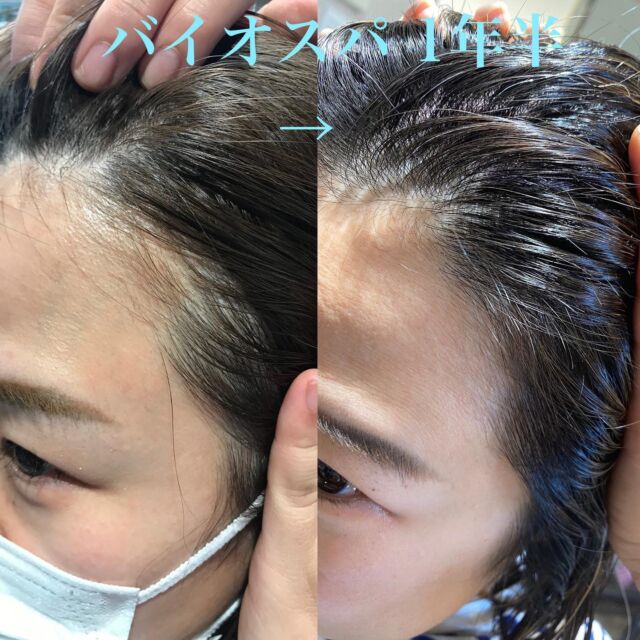 sheでバイオスパ が始まって1年半。　　
月1で続けているスタッフのbefore&afterです。　　

産毛で薄かった生え際の部分がしっかりとした毛が生えるようになり、埋まってきました！　　
髪にハリとコシが出てきたので、トップの毛がふんわりするようになりました✨　　
髪以外では、冷え性の改善があり、体温が1度上がって足先までポカポカしています、そのお陰かくすみがちだった顔色もいつも良いです。　　
あとは法令線が薄くなったのも実感しています！　　

バイオスパ は育毛といっても頭皮だけでなく、全身の血行を機械の力で効率良く回してくれるので、全身の血行が良くなりその結果色々な結果が出てきます✨どれも女性に嬉しい事ばかりなので、大人の女性の美容と健康にはぴったりだと実感しています🕊🕊 

1年以上続けてらっしゃるお客様にも効果が出てきています！が、なかなかお写真を頂くのは難しく…また感想を頂いてこちらにアップしていけたらと思っています✨　　

最近バイオスパ の問い合わせが多く、気になっているお客様が多いと感じています。sheでは個室で女性スタッフが1人で担当しますので、お話ししにくいお悩みも是非頂けたらと思います。

_______________________________

◯sheの育毛バイオスパ ◯

sheは女性のお客様お悩み専門美容院です。
その中でも薄毛のお悩みは本当に多く、年齢関係なく20代から悩んでいらっしゃる方も大勢います。
ふんわりして見える髪型やパーマをオススメする事しか出来なかったのが嫌で、
根本解決できるバイオスパ を始めました👩‍⚕️

▷バイオスパ って？
医療の現場でも使われている機械でのヘッドスパ。ヘルメットの中を真空にして加圧と減圧を繰り返す事で頭皮の血行をよくし、若い頃の髪質を取り戻します。

▷全身の血行も良くなるので、お顔のリフトアップ、冷え性改善、肩凝りの緩和、不眠改善など大人の方の不調に良い事だらけです。

▷4回目までで抜け毛が止まったと感じ、その後12〜18回程で生えてくる髪が違ってくるのを感じられる方が多いです。
その後はキープしていく為のバイオスパ になります
※回数はその方の体質、食事などにも寄ります

▷sheは
　✨愛知県豊橋市東橋良町
　✨静岡県浜松市西区大平台　　の2店舗

全店舗、個室だけの美容院で女性スタイリストがマンツーマンで対応します。
育毛だけでは無いヘアサロンなので他の方の目を気にせず育毛が受けられます。
もちろんカットやカラーも同時に可能🙆‍♀️
カラーのついでに根本的なエイジングケアが受けられます🙆‍♀️

_______________________________

💁‍♀️ご予約、お問い合わせはDM又はプロフィールにあるホームページからお気軽にご連絡下さい。

▷愛知県豊橋市東橋良町
▷静岡県浜松市西区大平台　　　の2店舗

30代後半〜70代のお客様がいらっしゃっています。育毛本気で取り組んでます！
______________________________
 【コロナ対策の為、消毒とマスクの着用をお願いしております。】
_______________________________

#豊橋バイオスパ #豊橋美容院#豊橋育毛#豊川育毛
#豊川バイオスパ #豊川美容院#豊橋ヘアサロン#豊橋スタイリスト募集
#バイオスパ#抜け毛予防#浜松育毛＃美髪#アンチエイジング #浜松美容院 #リフトアップ＃薄毛 #biospa  #浜松バイオスパ